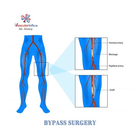 popliteal artery surgery